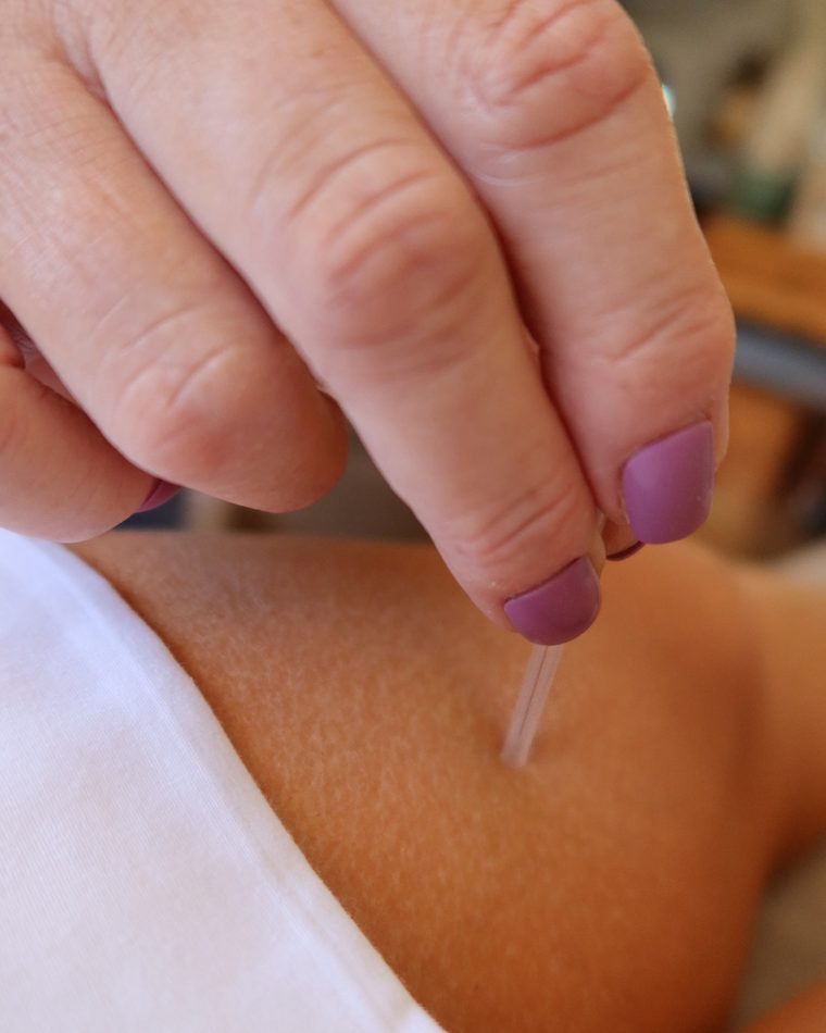 Amie Guerra placing an acupuncture needle during a fertility acupuncture treatment