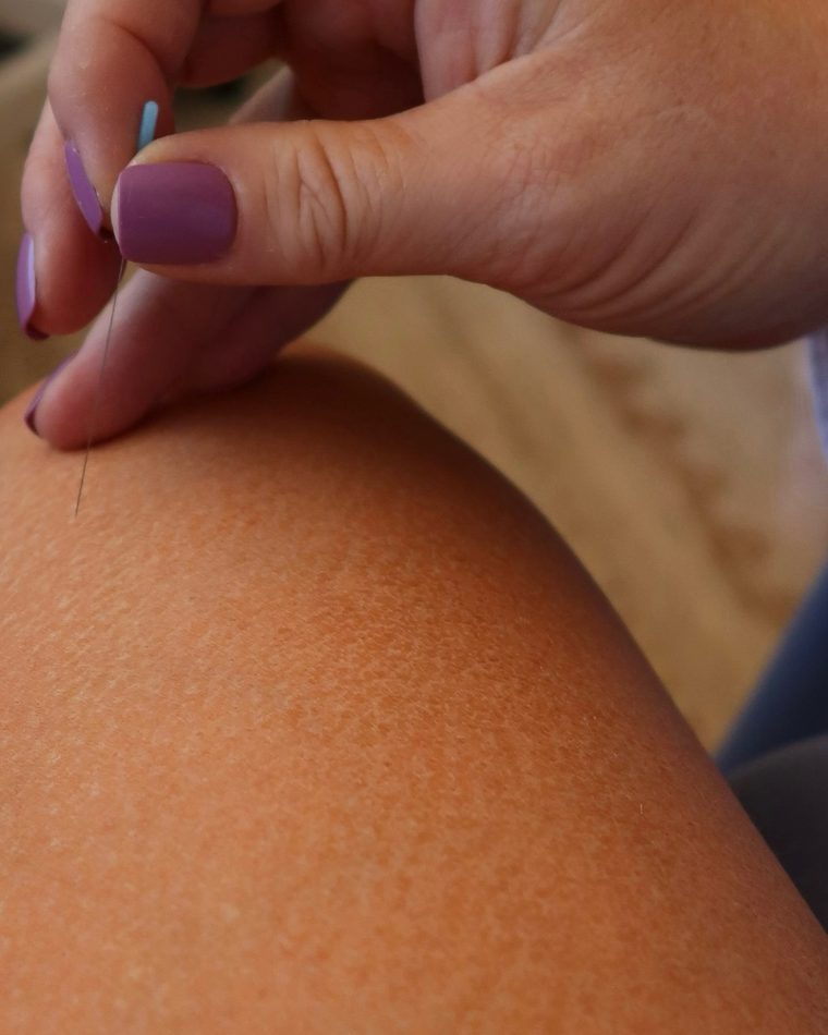Acupuncture needle being placed during a fertility treatment at AZ Fertility Acupuncture