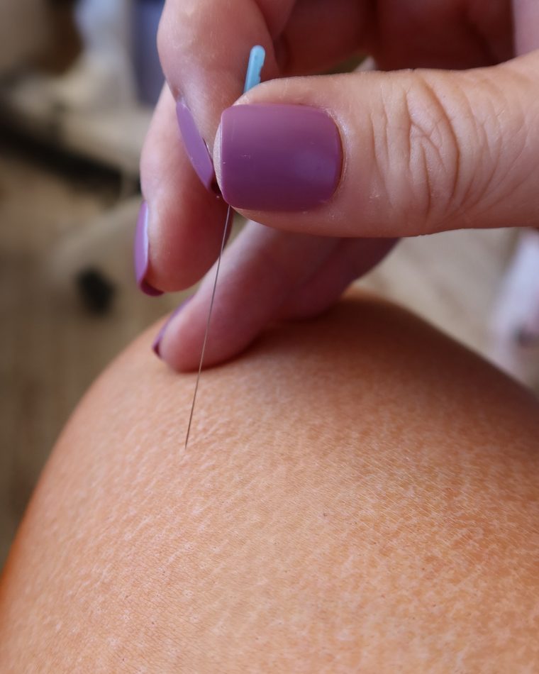 Close view of a single acupuncture needle placed during fertility acupuncture